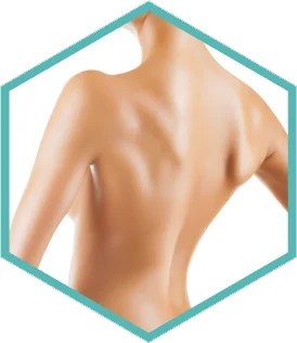 Hexagon crop of the back treatment area for Lumecca IPL photofacial in London